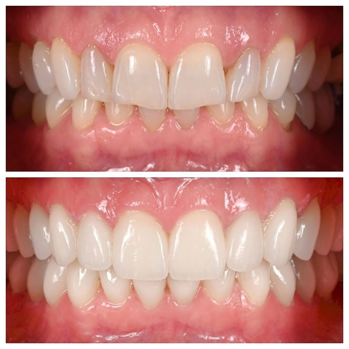 Before and after smile makeover results – improved teeth alignment and whitening