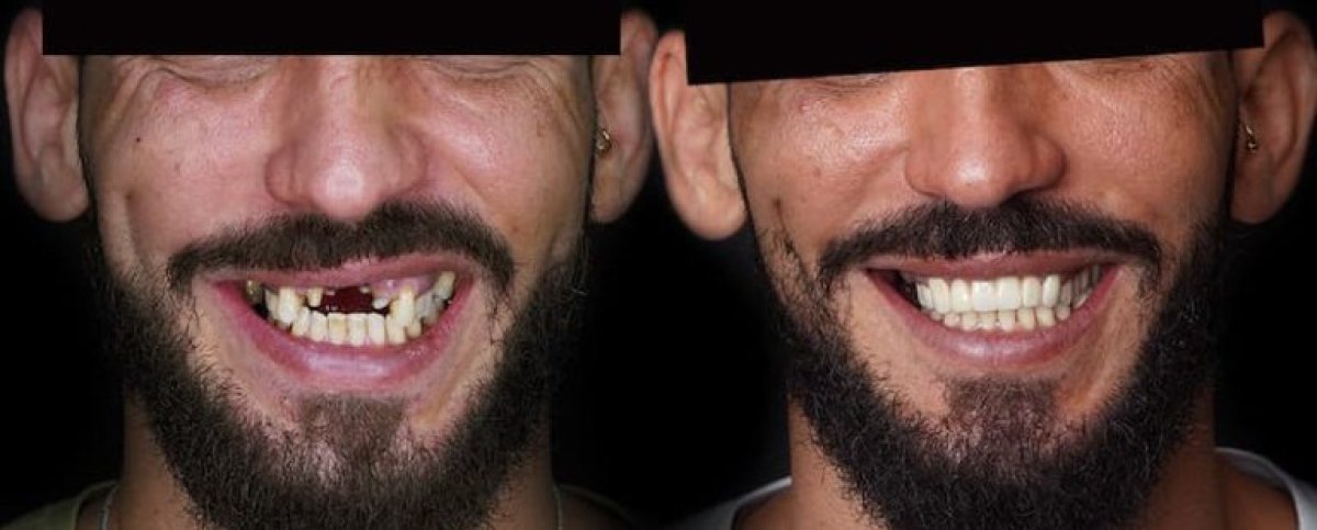 Smile makeover before and after results – full dental restoration with veneers and implants
