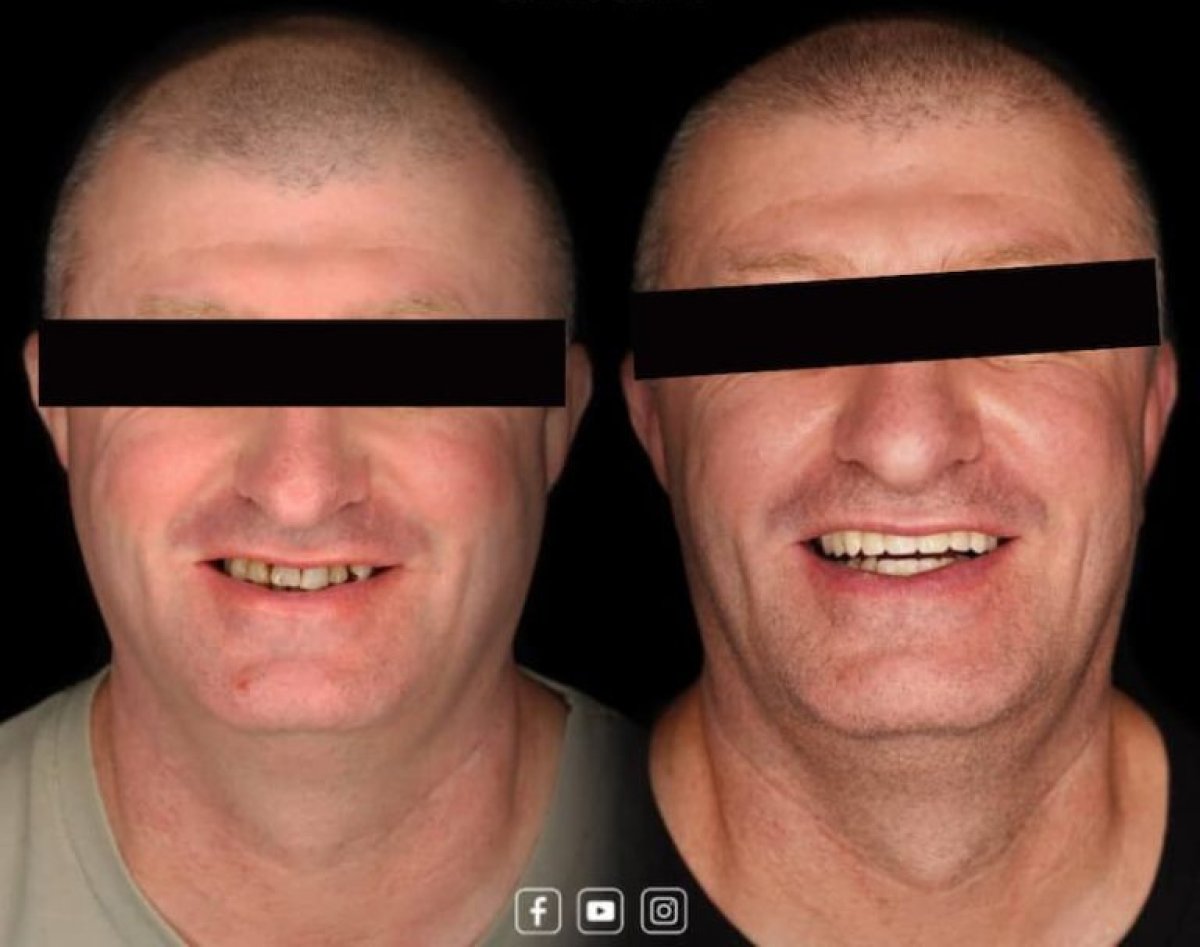 Smile makeover before and after results – improved teeth alignment and whiter smile