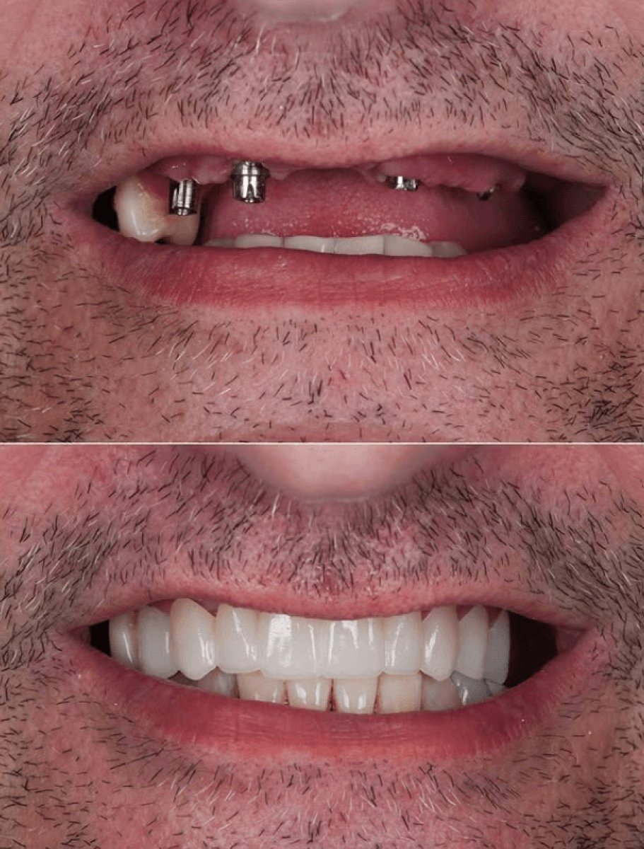 Before and after dental implant results – restored smile and teeth replacement