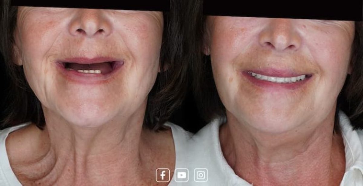 Before and after dental implant results – restored smile and teeth replacement