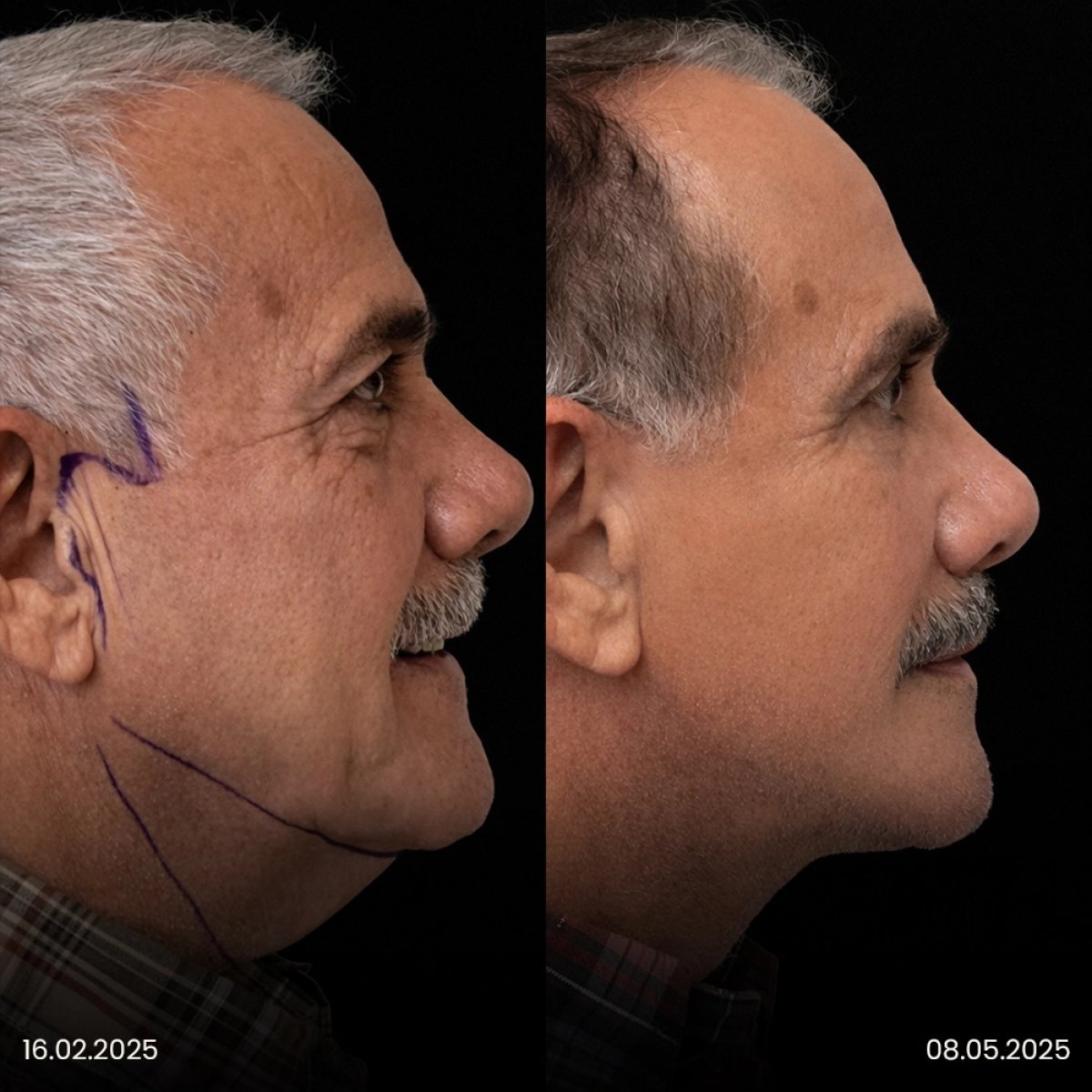 Facelift before and after results in male patient – visible jawline and neck lift improvement