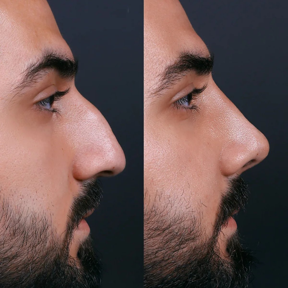 نتائج عملية تجميل الأنف قبل وبعد لدى رجل، إعادة تشكيل الأنف بمظهر طبيعي