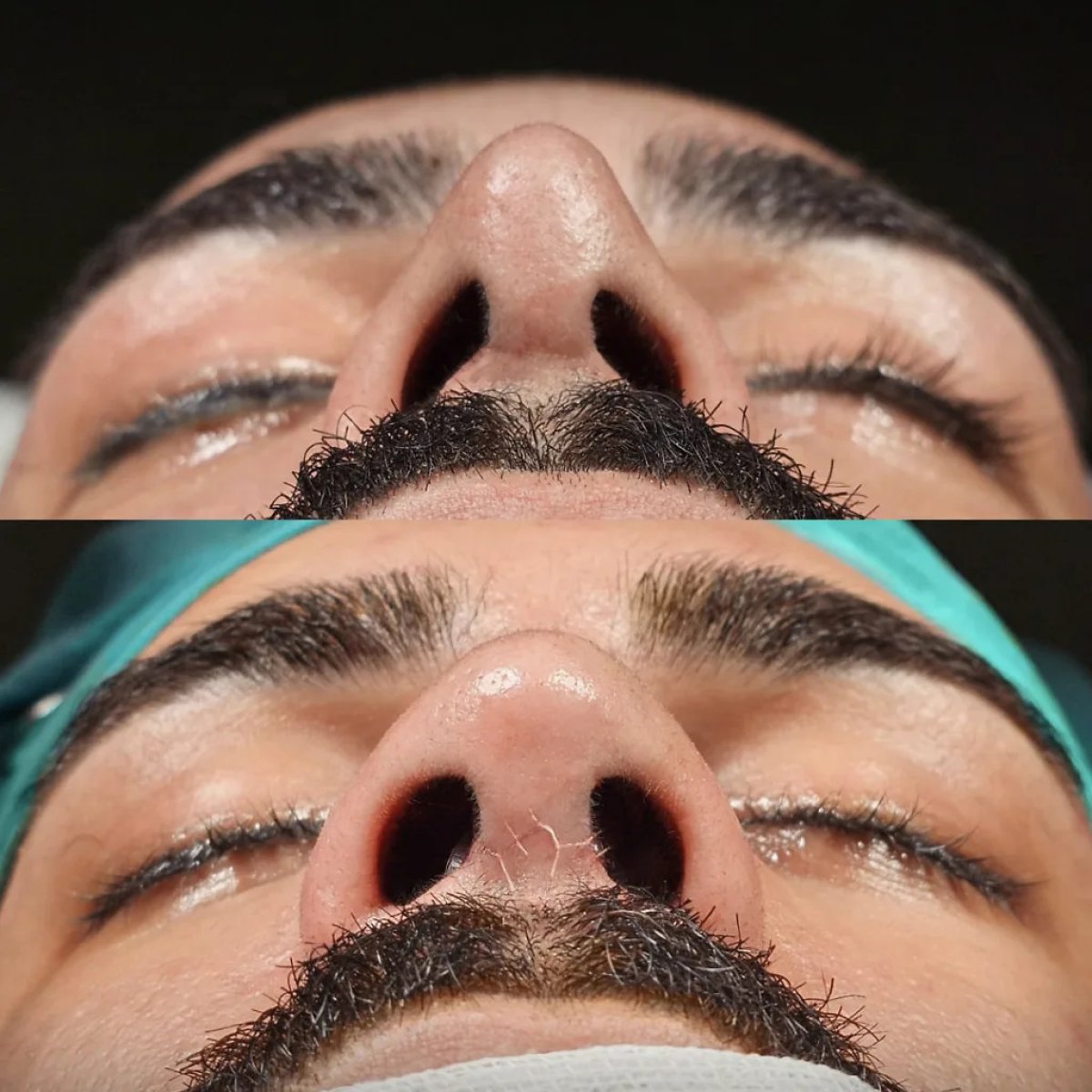 نتائج تجميل الأنف قبل وبعد، تحسين شكل وتناسق الأنف لدى مريض ذكر