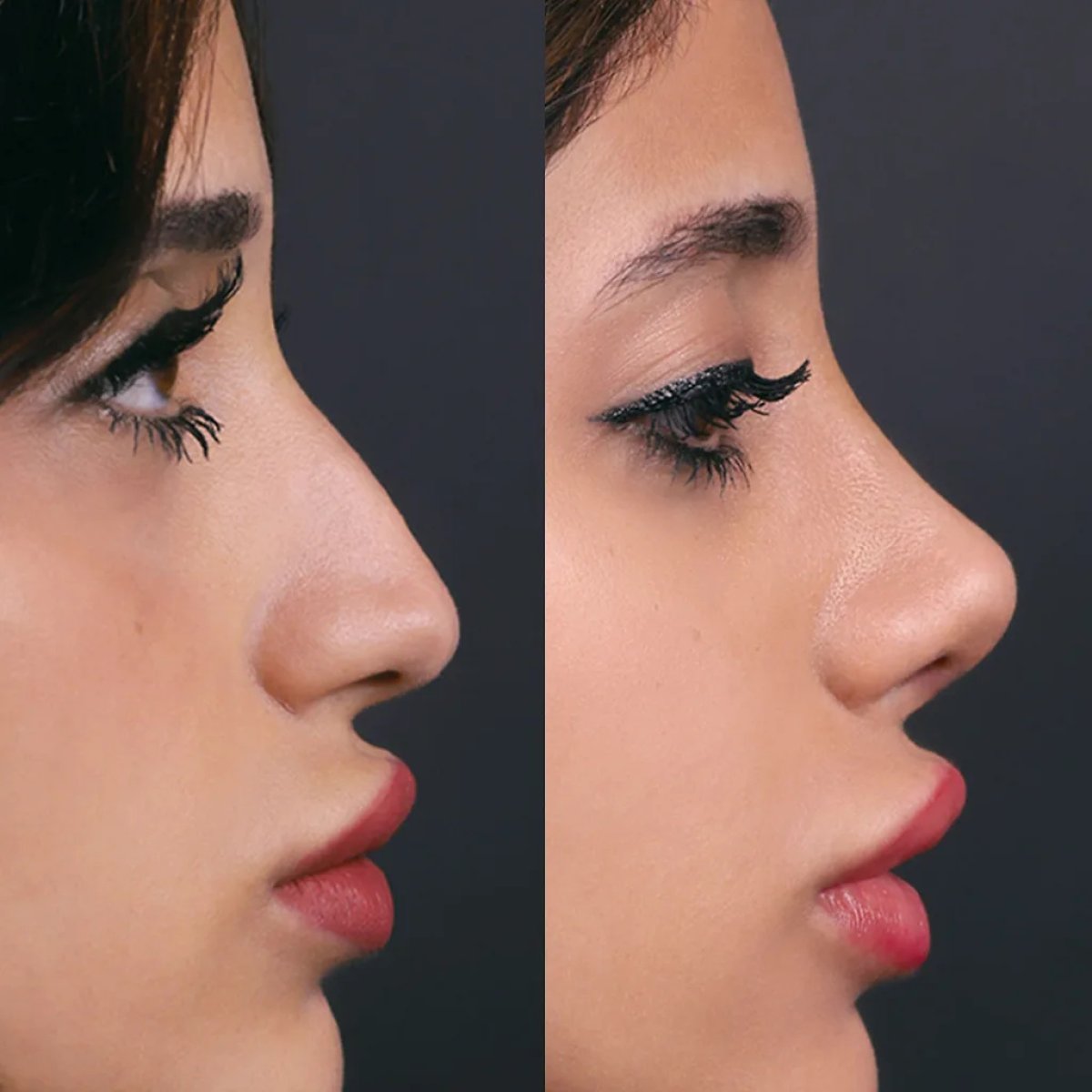 نتائج عملية تجميل الأنف قبل وبعد، إعادة تشكيل الأنف وتحسين المظهر الجانبي