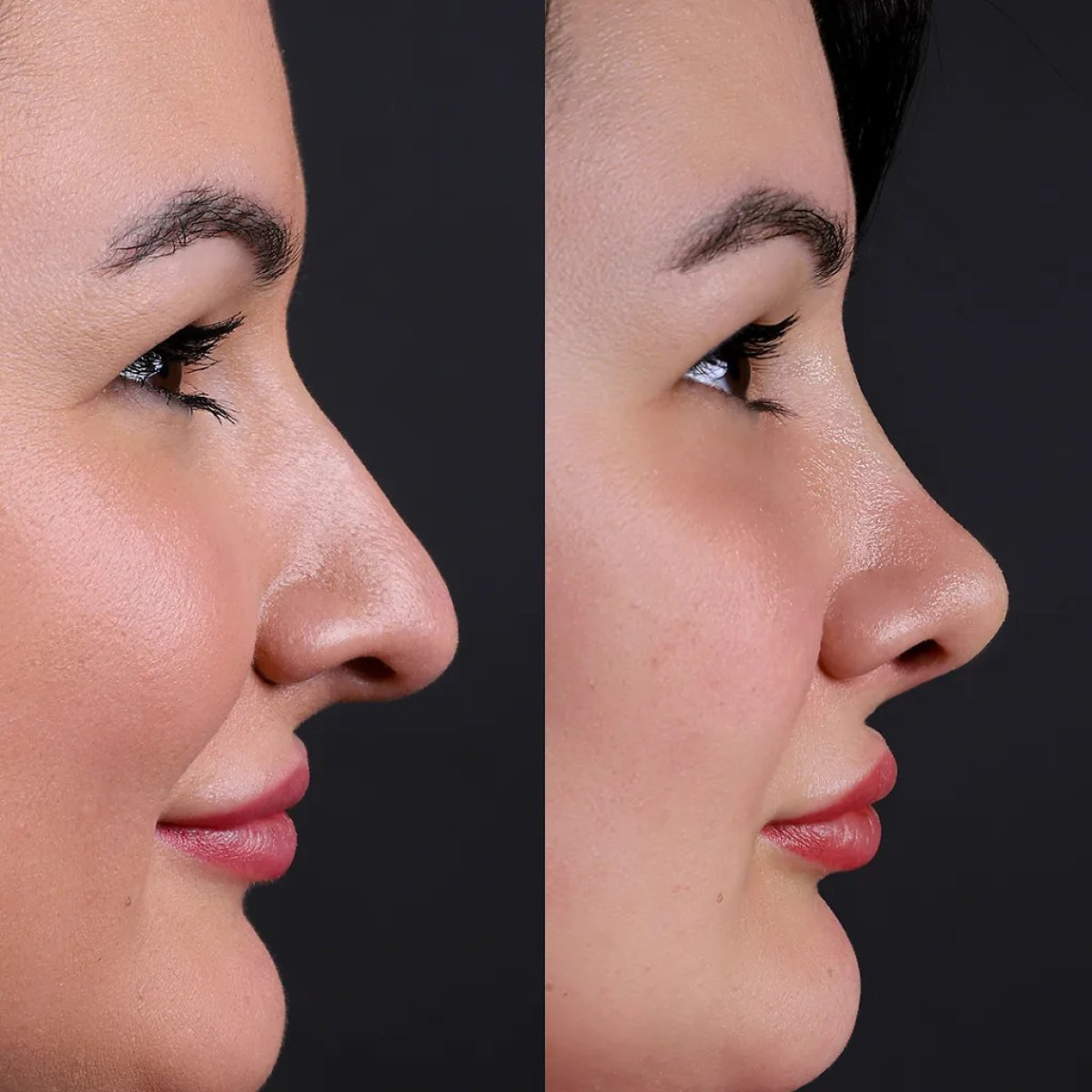 Before and after rhinoplasty results, nose reshaping for improved profile and natural look