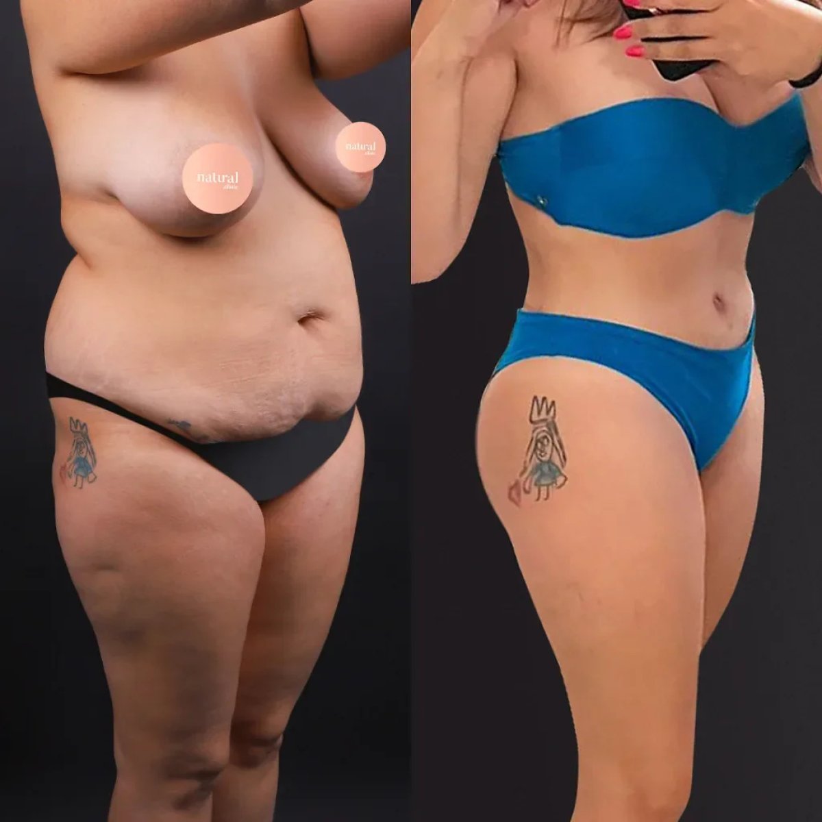 Résultats avant et après liposuccion – amélioration visible du contour et réduction de graisse