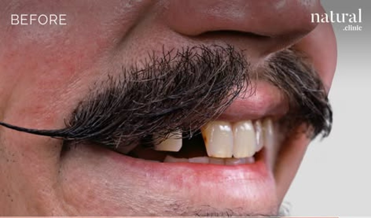 Vor der Porzellanveneers-Behandlung in der Natural Clinic, sichtbare Zahnverfärbungen und Lücken