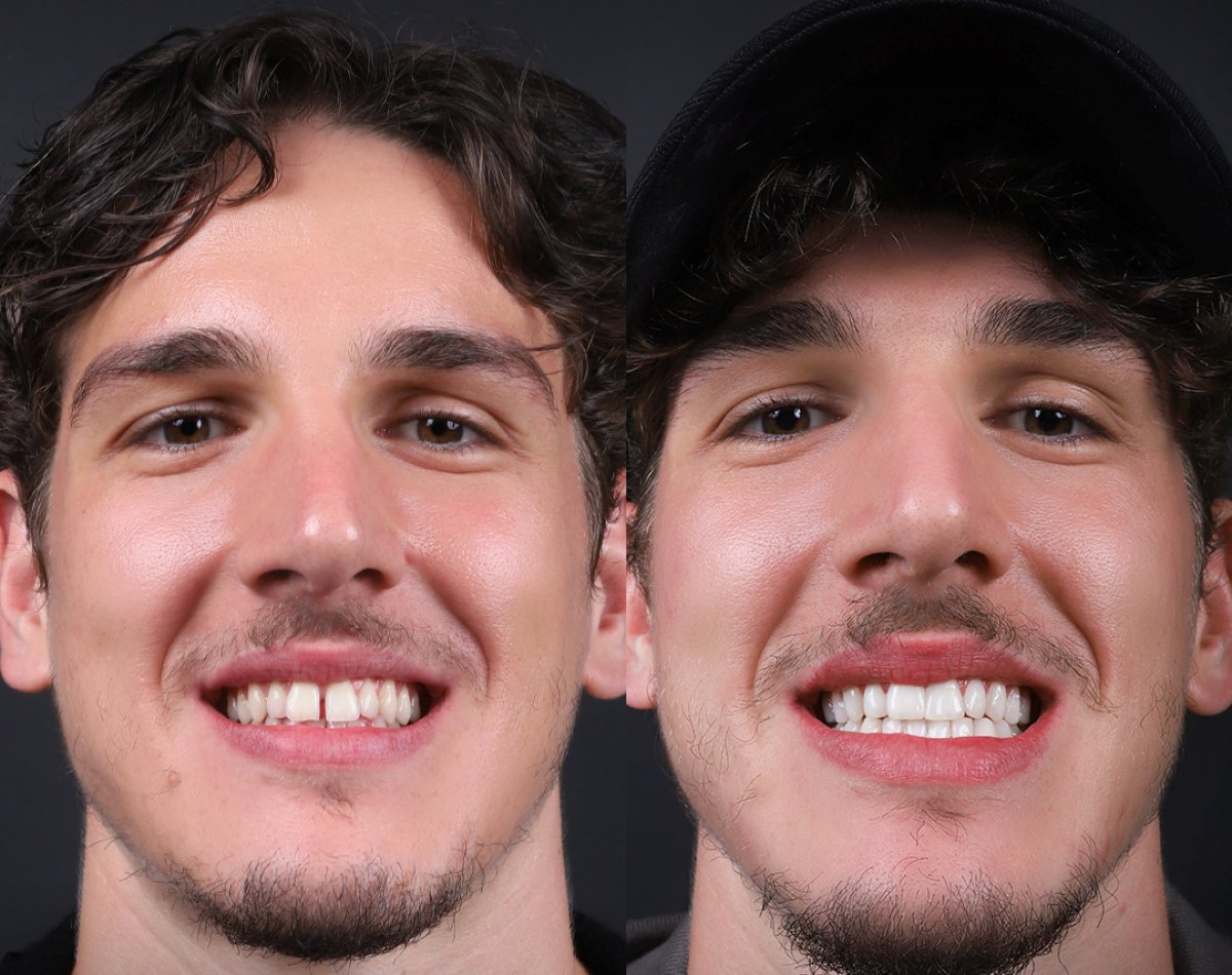 Resultado antes y después de carillas dentales – sonrisa más blanca y uniforme