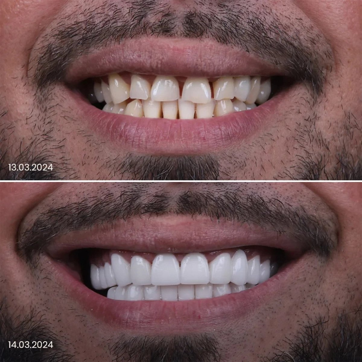 Resultado antes y después de carillas: sonrisa transformada con dientes blancos y parejos