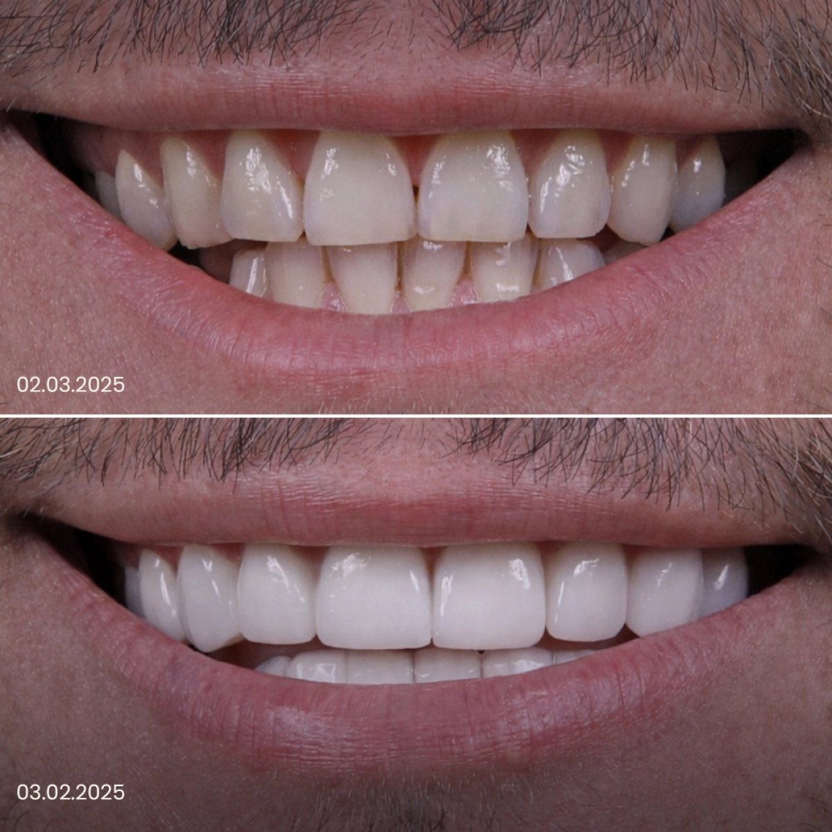 Before and after veneers result – smile transformation with whiter, even teeth