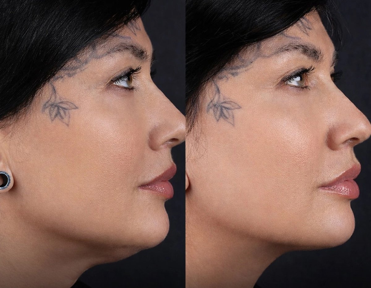 Before and after chin liposuction results – improved jawline contour and reduced fullness