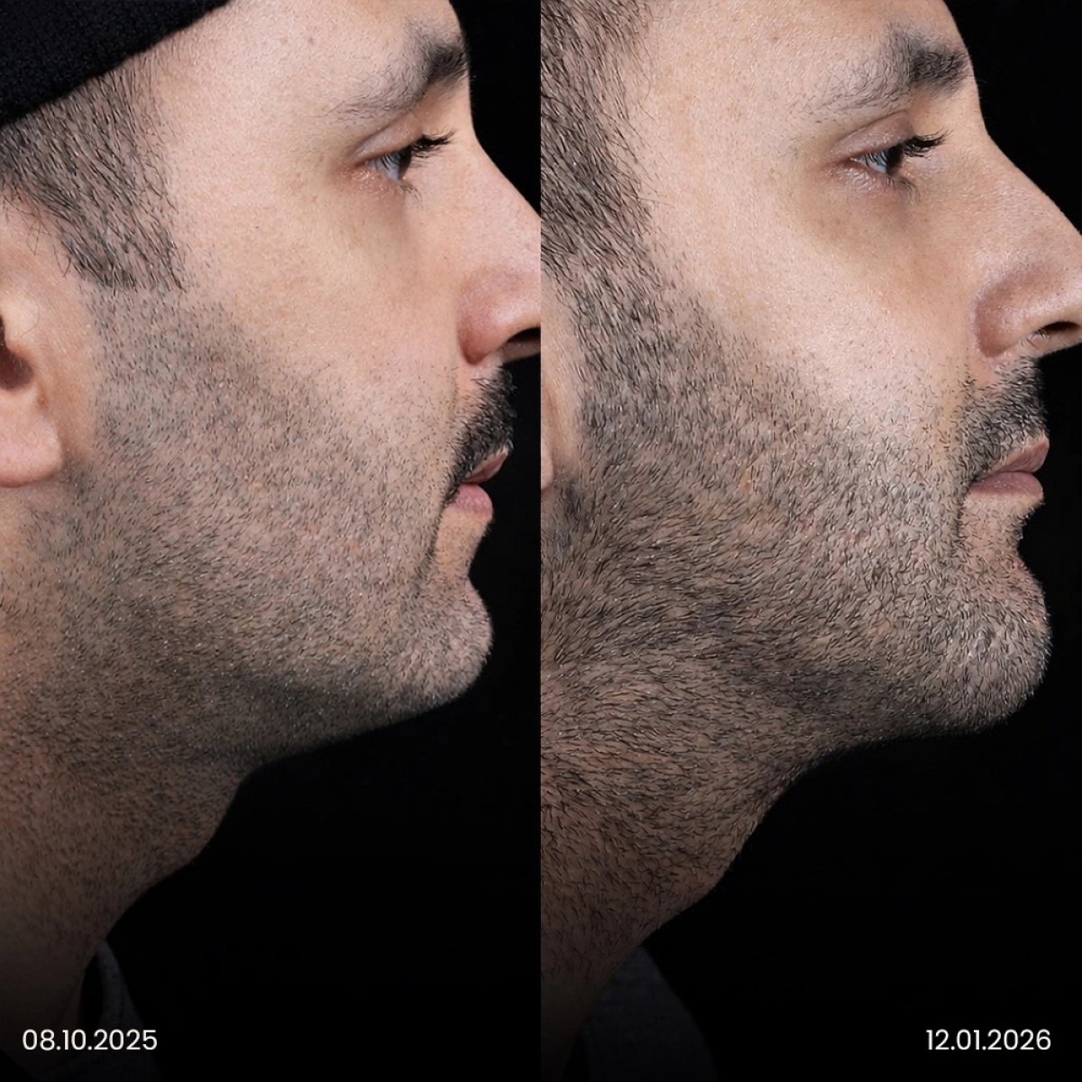Before and after chin liposuction results in male patient – improved jawline contour