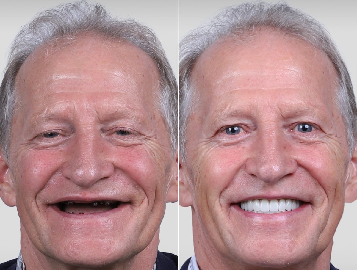 Before and after dental implant results – restored smile and teeth transformation