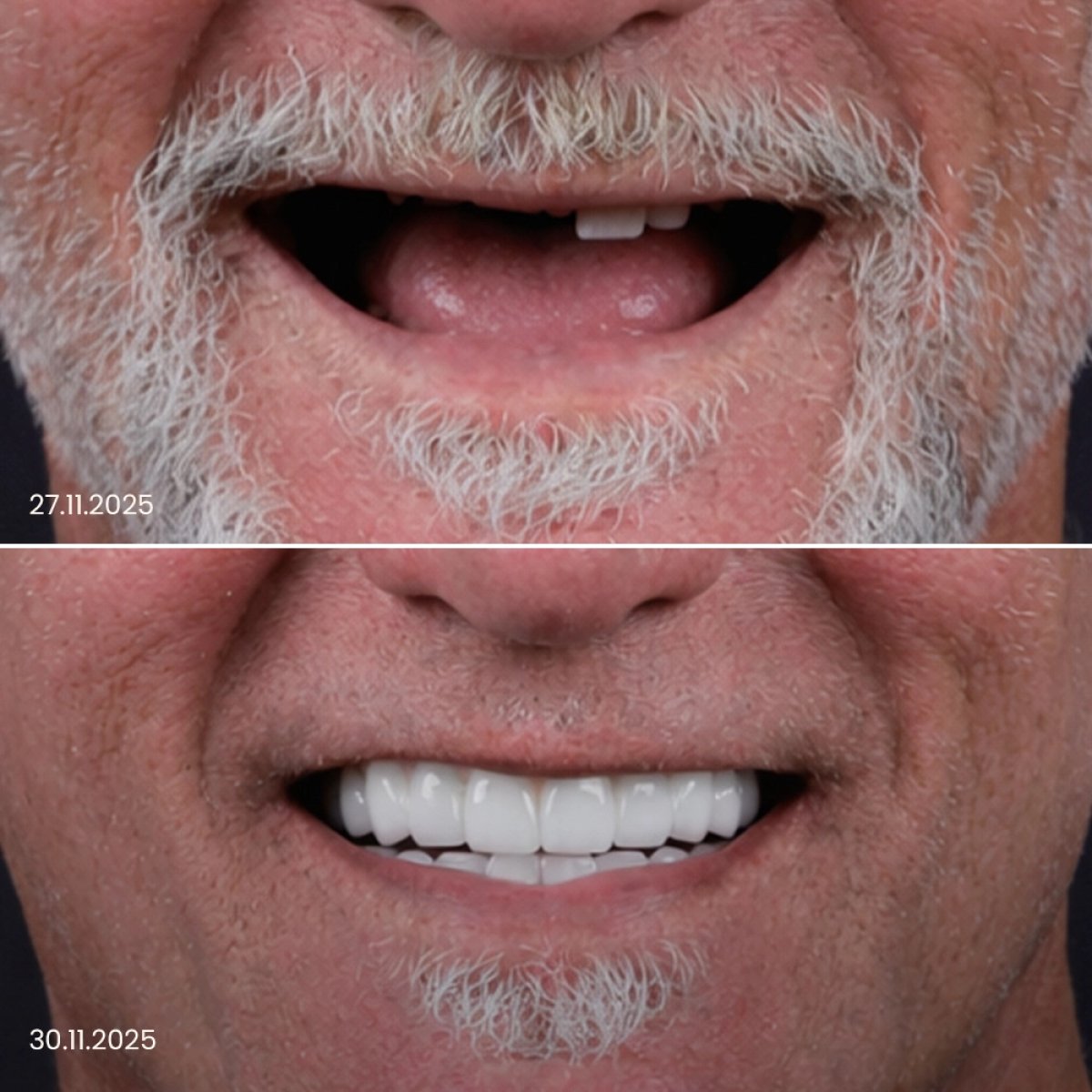Résultats avant et après implants dentaires – sourire restauré et transformation dentaire
