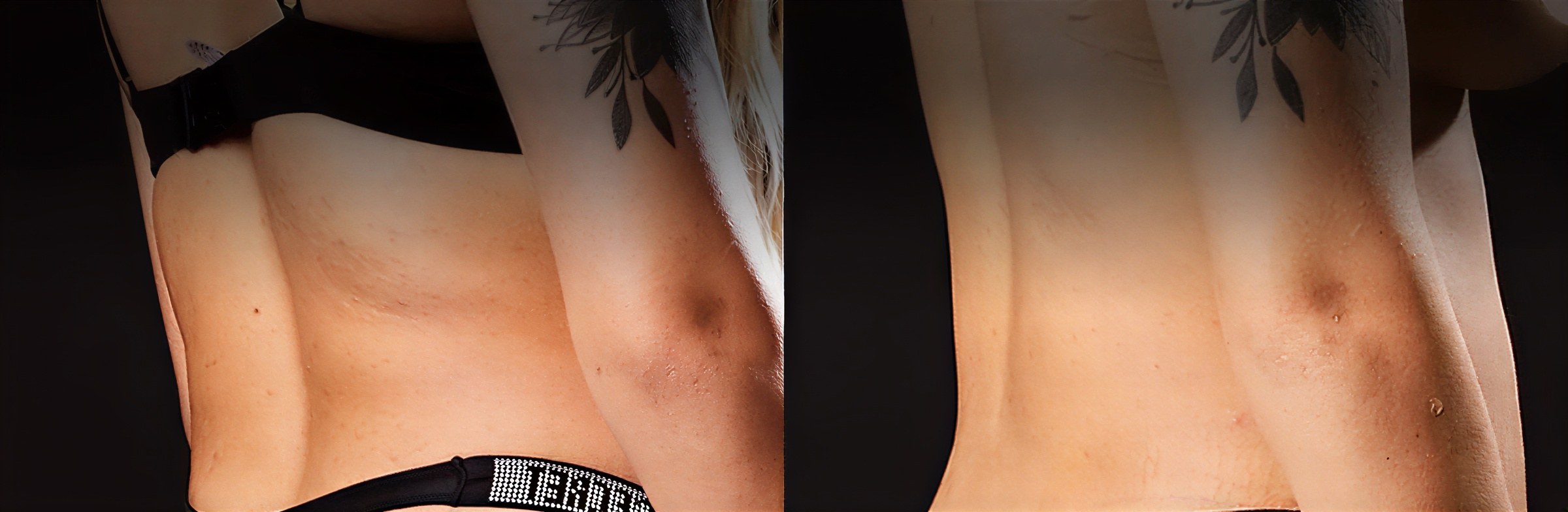 Resultados antes y después de Brazilian Butt Lift – contorno mejorado y espalda baja suave