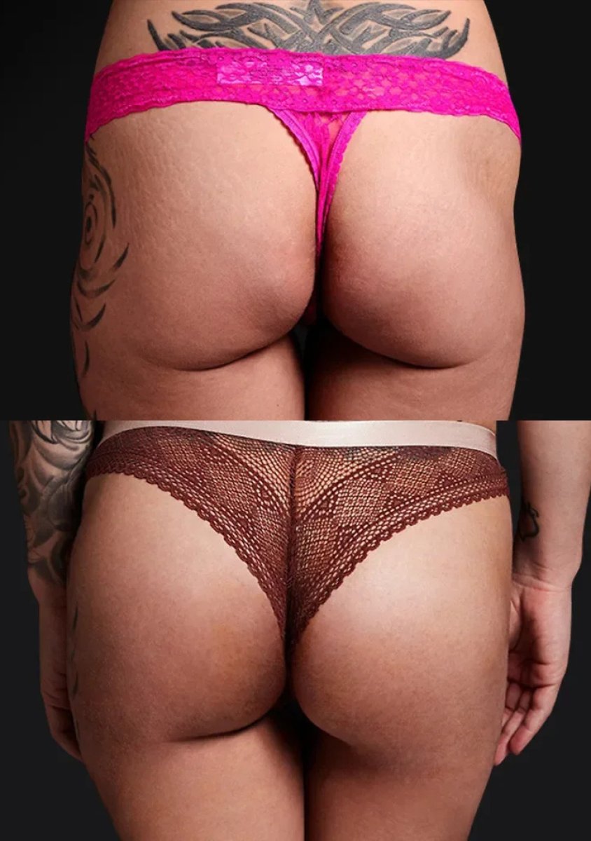 نتائج قبل وبعد عملية Brazilian Butt Lift – تحسين شكل وحجم الأرداف