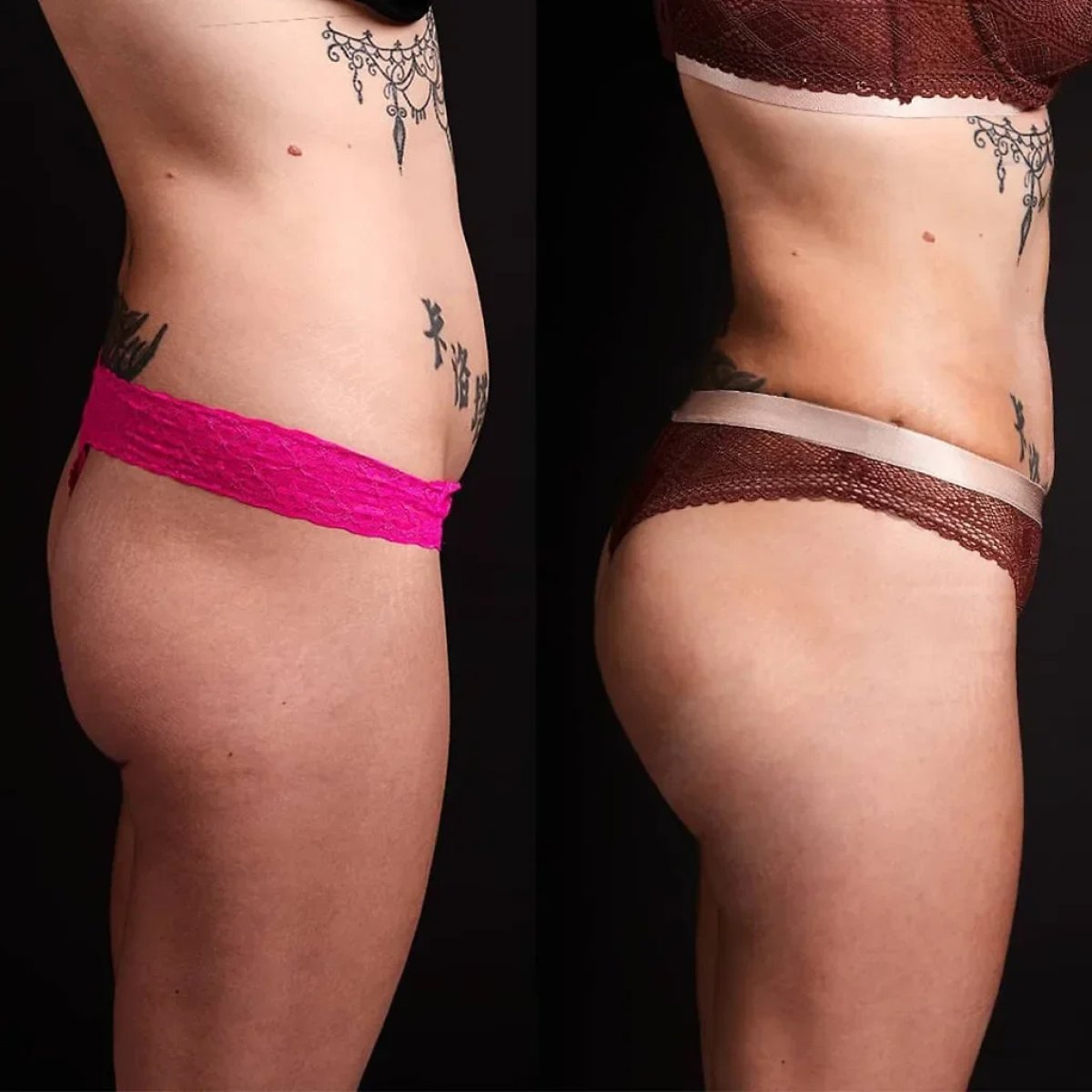 Efekty przed i po Brazilian Butt Lift – lepszy kształt i objętość pośladków