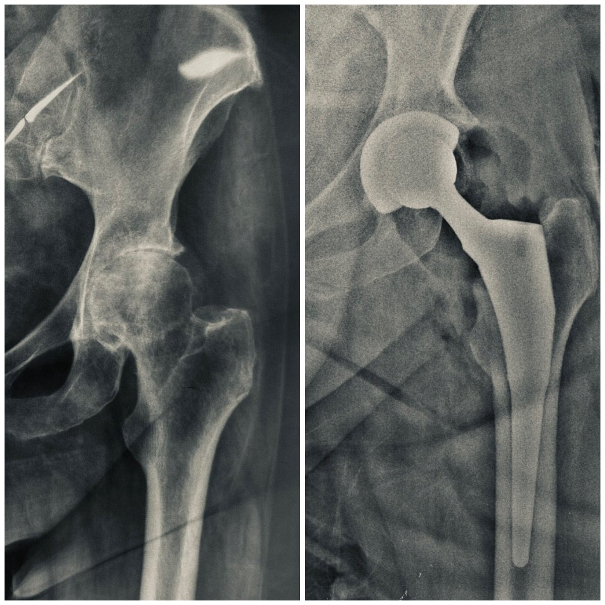 Before and after hip replacement X-ray results showing improved joint structure after surgery