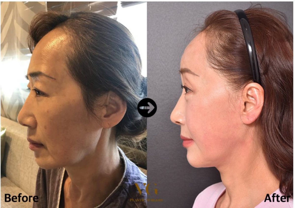 Vorher-nachher-Ergebnis Lipofilling im Gesicht bei VG Plastic Surgery – Verjüngung