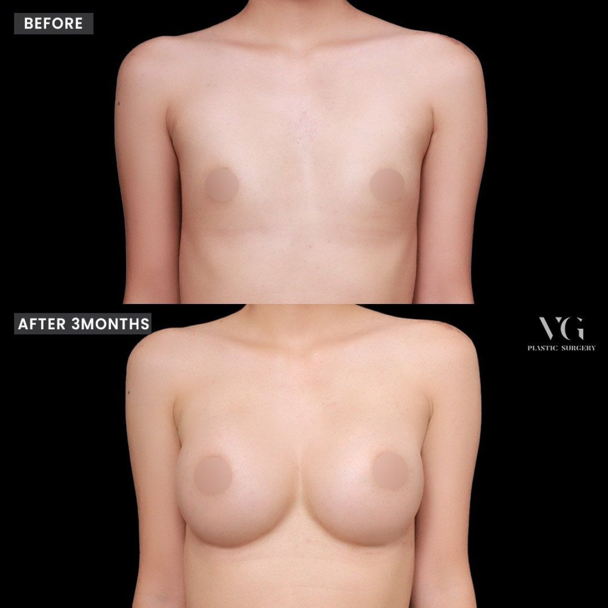 Before and after breast augmentation with fat transfer at VG Plastic Surgery, natural results