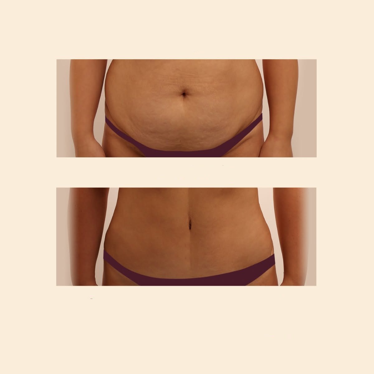Resultados antes y después de abdominoplastia y liposucción en InSense Clinic (SV Plastic Surgery Clinic)