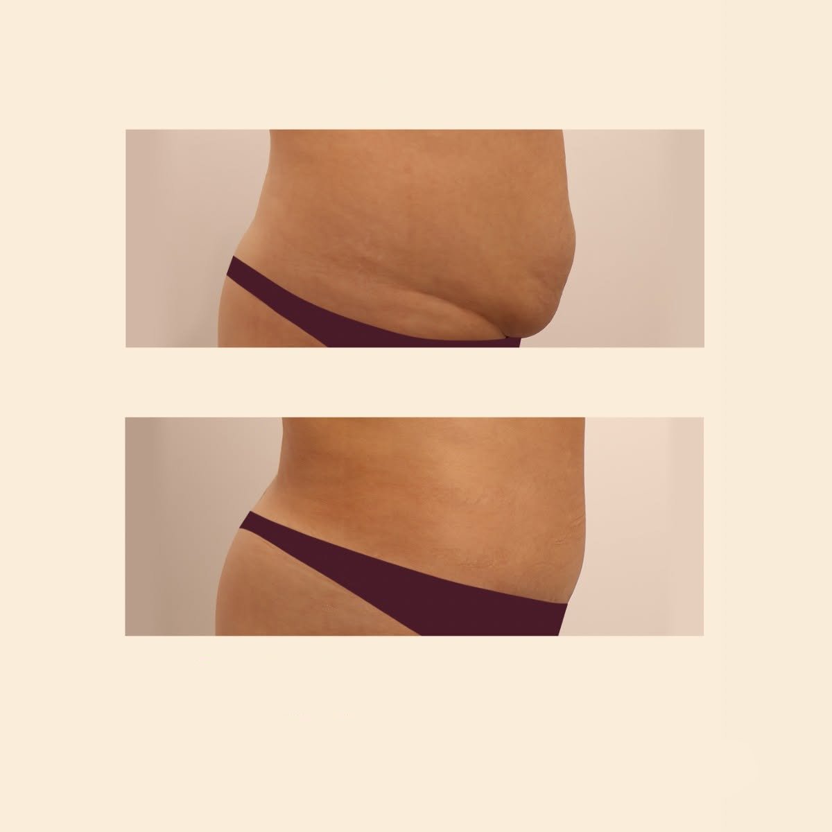 Resultados de abdominoplastia y liposucción antes y después en InSense Clinic, abdomen plano