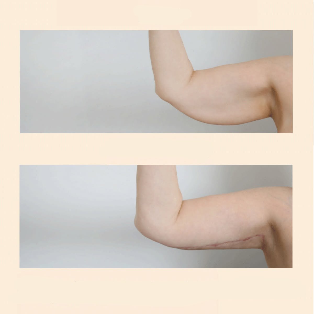 Resultados antes y después de lifting de brazos (braquioplastia) en InSense Clinic (SV Plastic Surgery Clinic)
