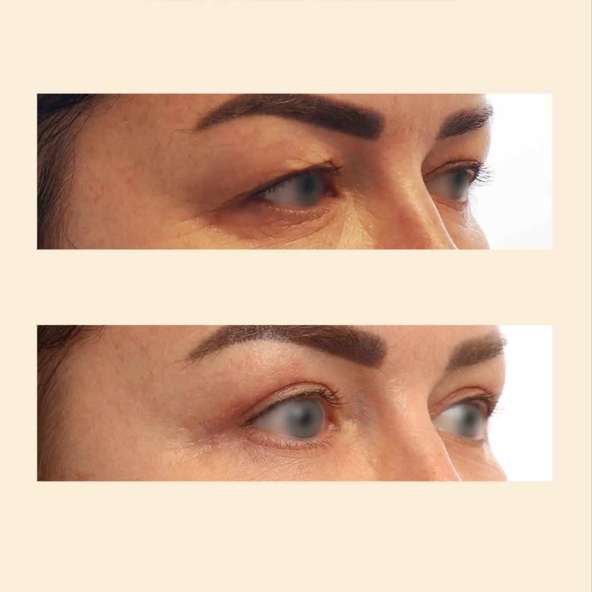 Resultados antes y después de blefaroplastia en InSense Clinic (SV Plastic Surgery Clinic), lifting de párpados