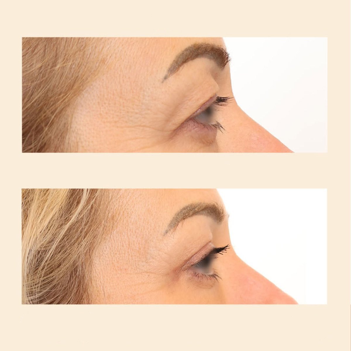 نتائج شد الجفون قبل وبعد في InSense Clinic (SV Plastic Surgery Clinic)، تصحيح الجفون