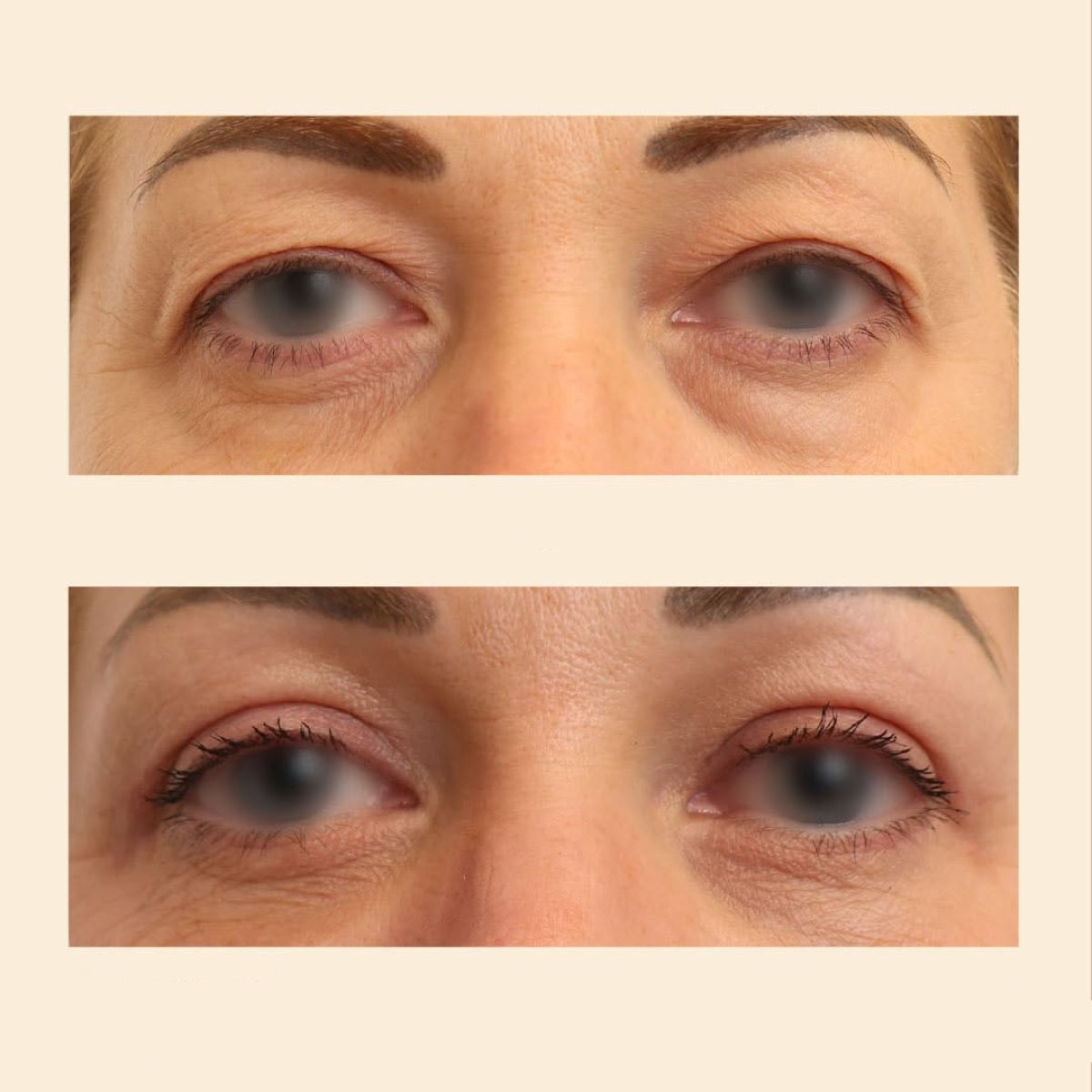 Результаты блефаропластики до и после в InSense Clinic, коррекция век для молодого взгляда
