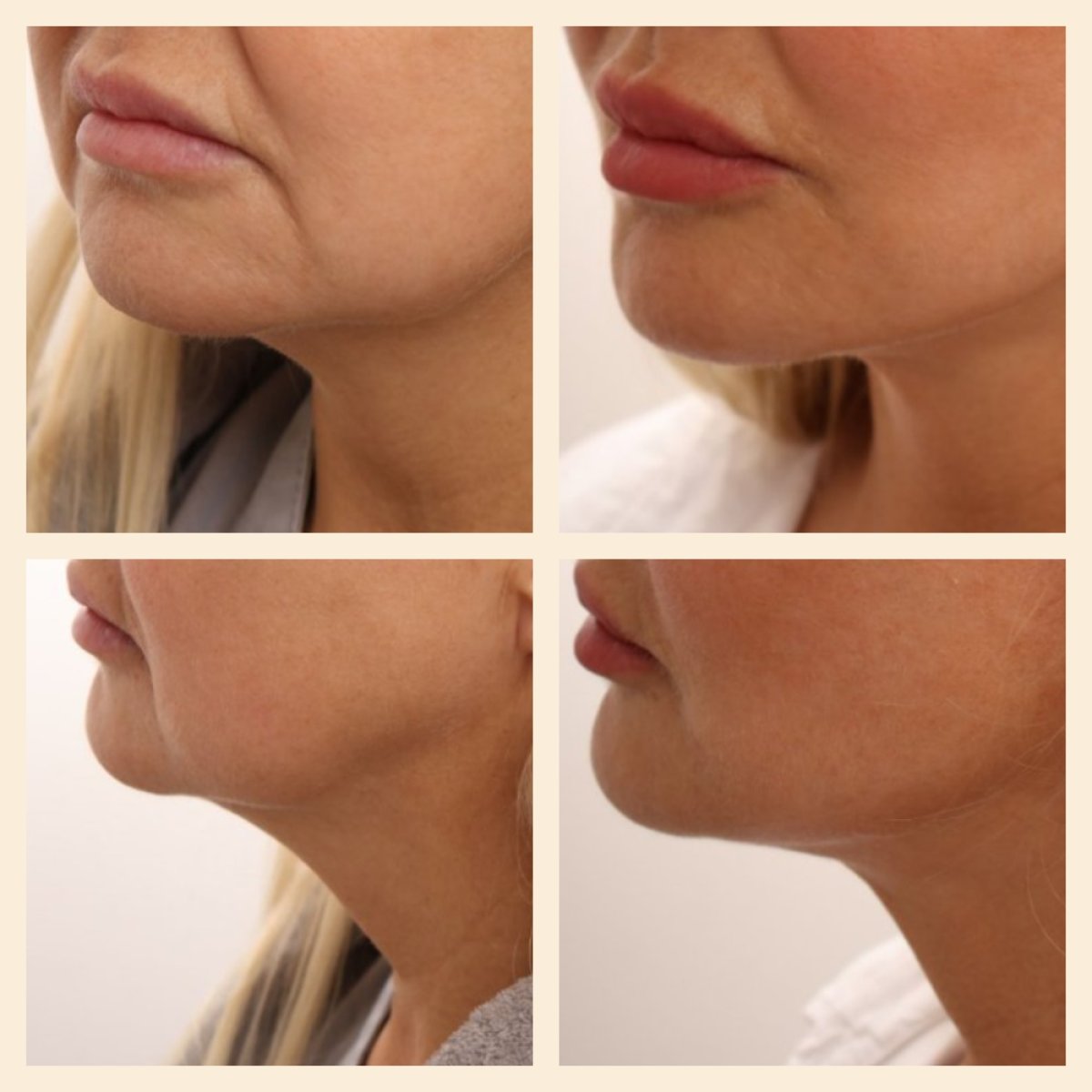 Resultados de lifting facial antes y después en InSense Clinic (SV Plastic Surgery Clinic), rejuvenecimiento de la mandíbula