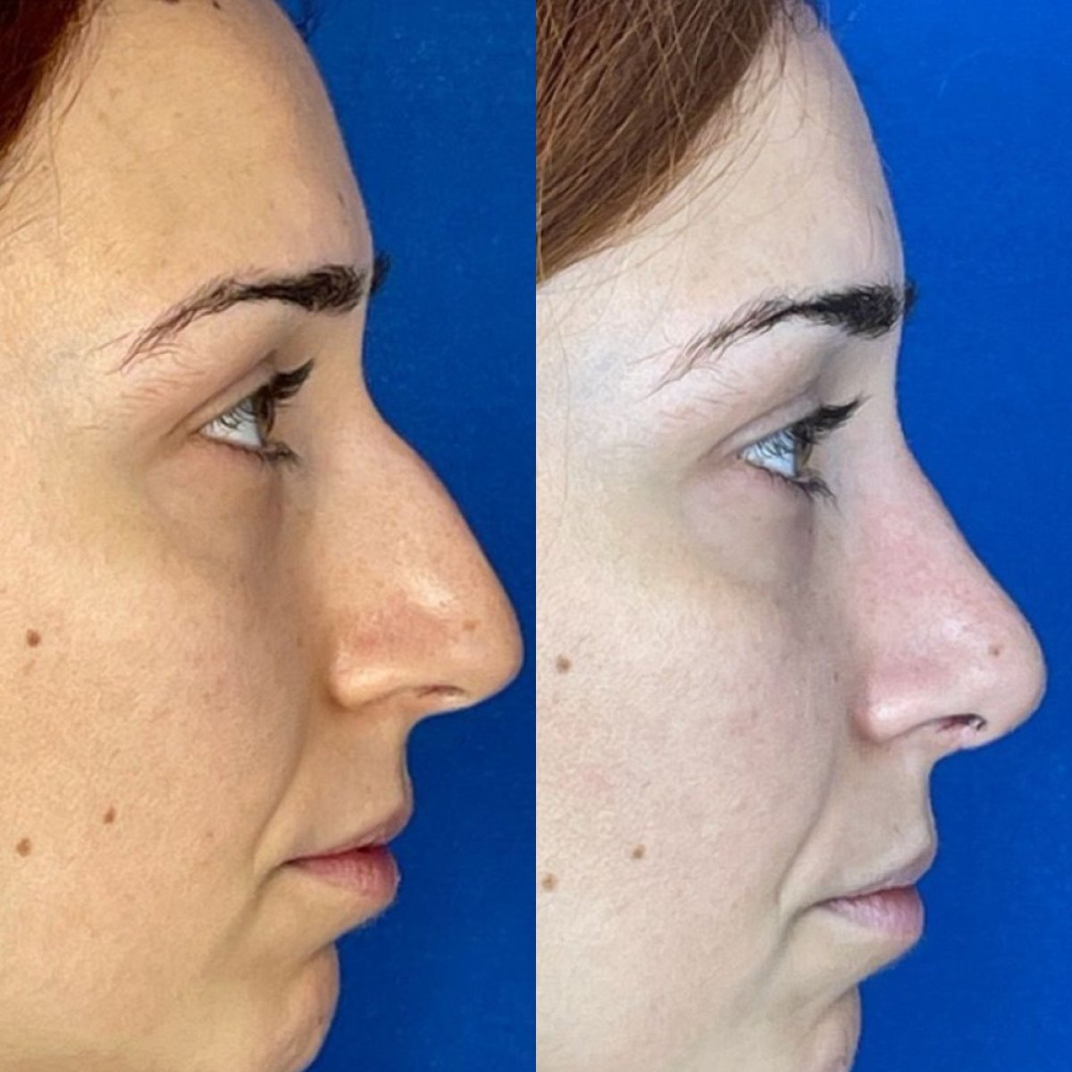 Before and after septoplasty results at Memorial Antalya Hospital for deviated septum correction