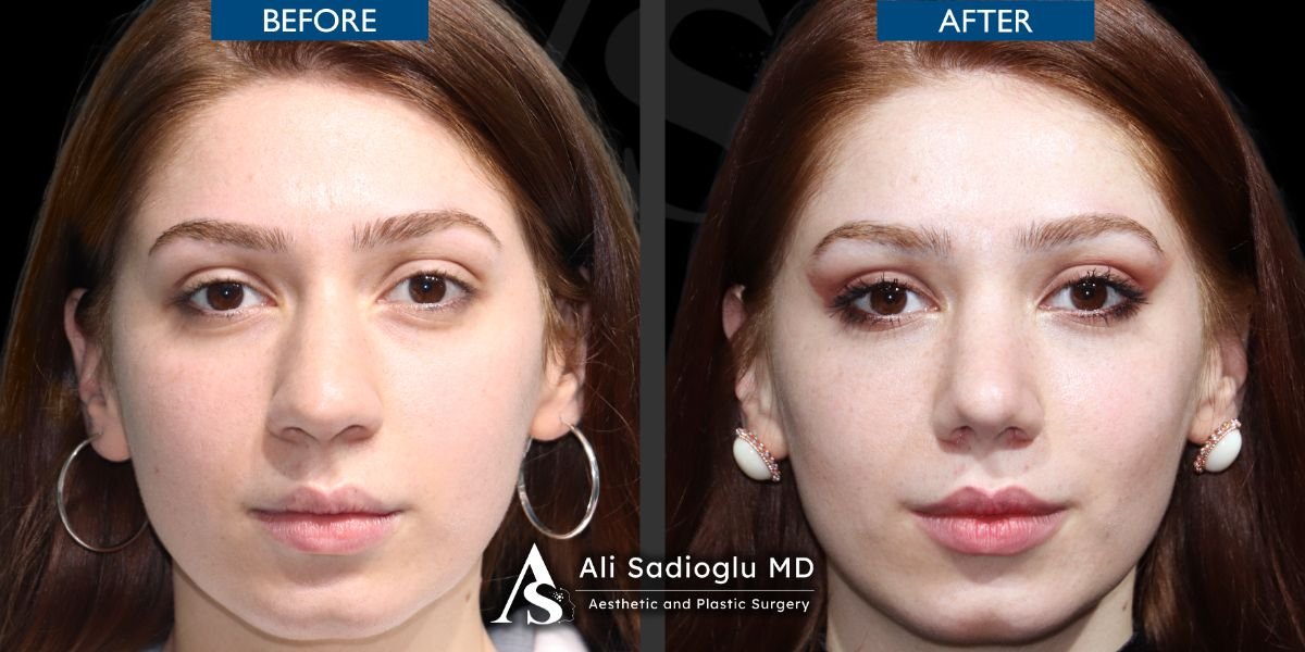 Resultados de rinoplastia antes y después en Dr. Safa Manav Clinic, mejora de la nariz