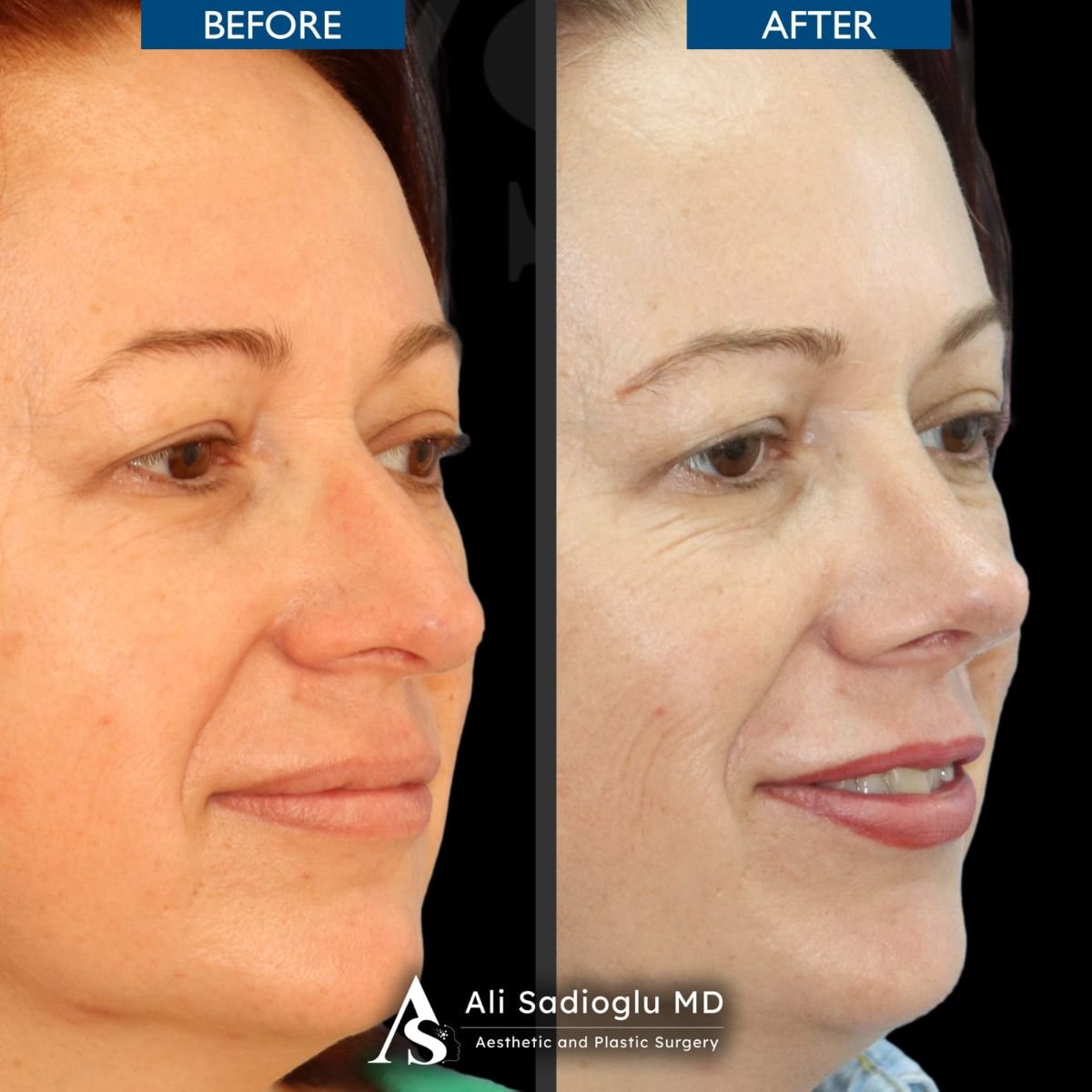 Resultados de rinoplastia antes y después en Dr. Safa Manav Clinic, mejora visible de la nariz