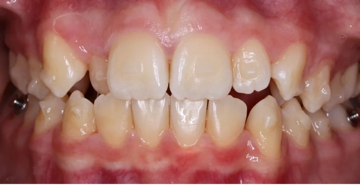 Résultat avant traitement Invisalign – dents encombrées et mal alignées avant la procédure
