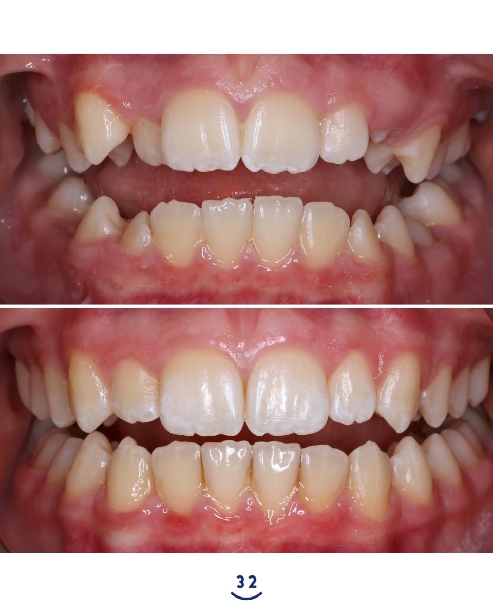 Résultats avant et après Invisalign : dents alignées et sourire amélioré