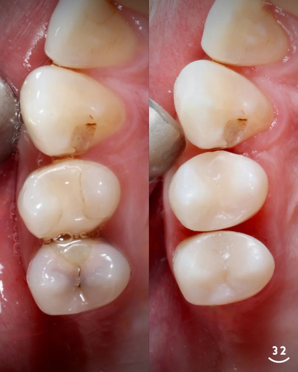 Before and after tooth restoration (bonding) results – improved molar appearance and health