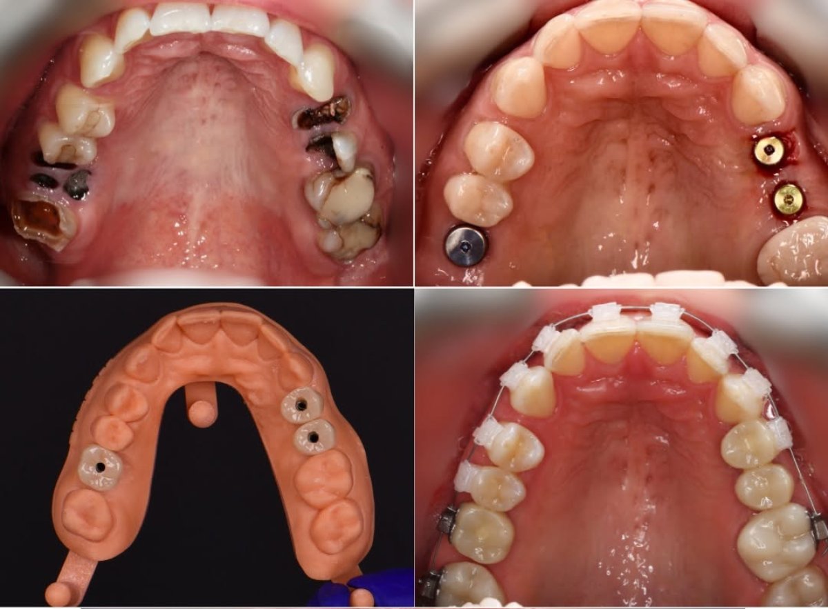 Efekty przed i po implantach zębowych i ortodoncji przy odbudowie górnych zębów