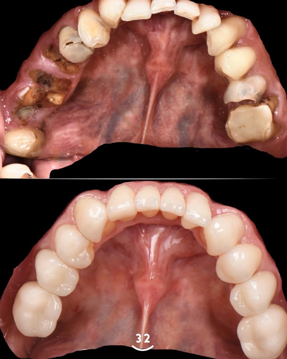 Before and after tooth restoration (bonding) results – upper teeth transformation