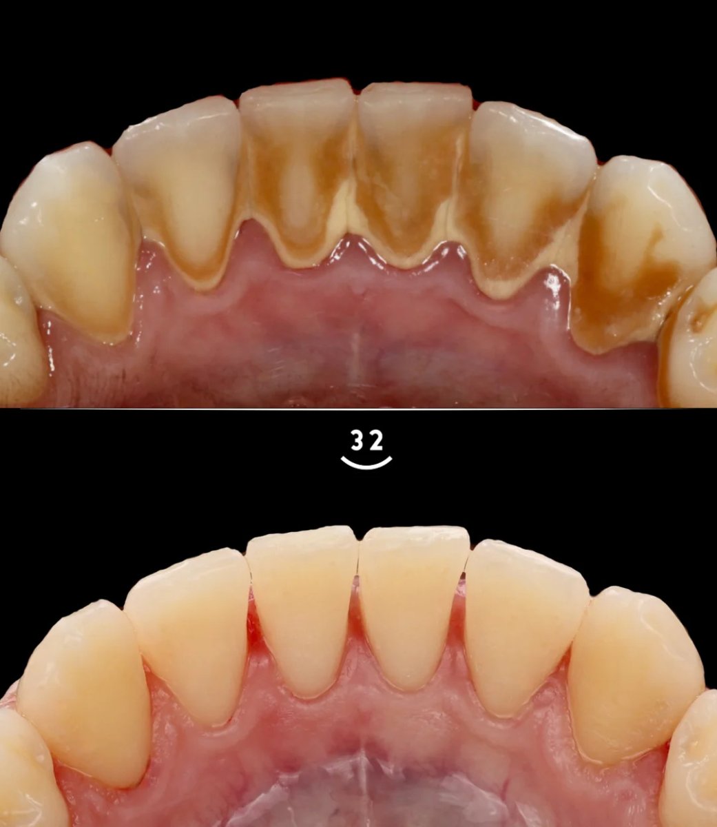 Resultados de limpieza dental (raspado) antes y después – eliminación de placa y dientes más blancos