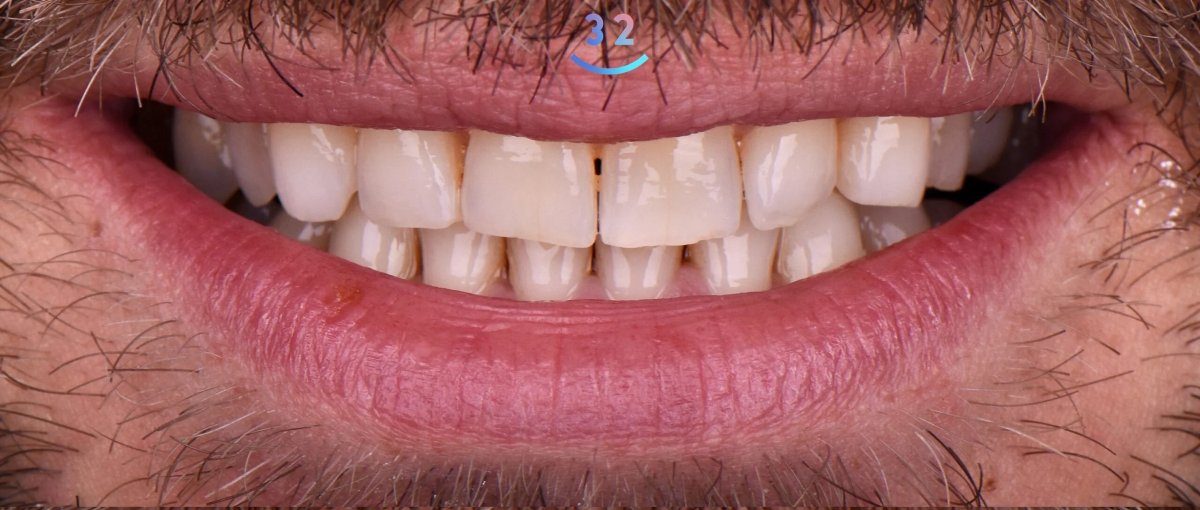 Smile transformation after dental veneers procedure at 32 Clinic, natural-looking result