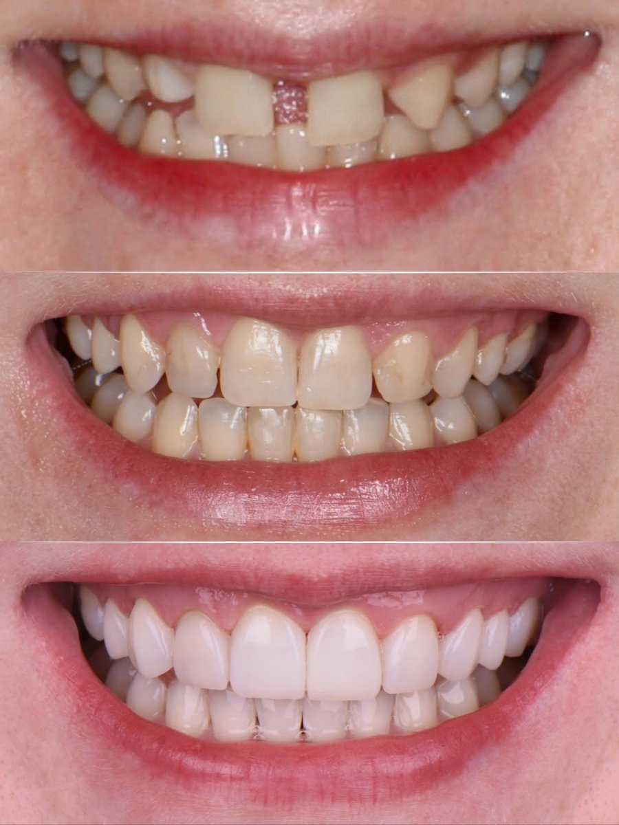 Smile makeover before and after results – dental veneers for whiter, even teeth transformation