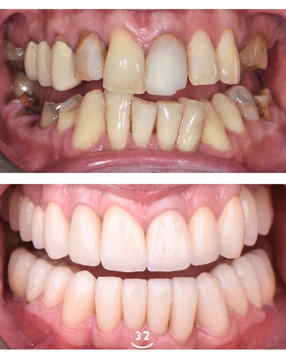 Smile makeover before and after results – dental veneers for whiter, even teeth transformation