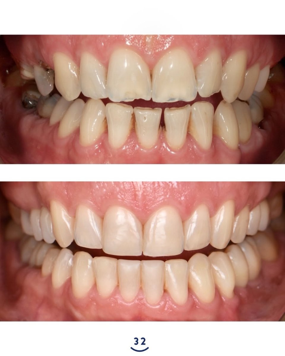 نتائج قبل وبعد تجميل الابتسامة – تحسين لون ومحاذاة الأسنان في عيادة الأسنان