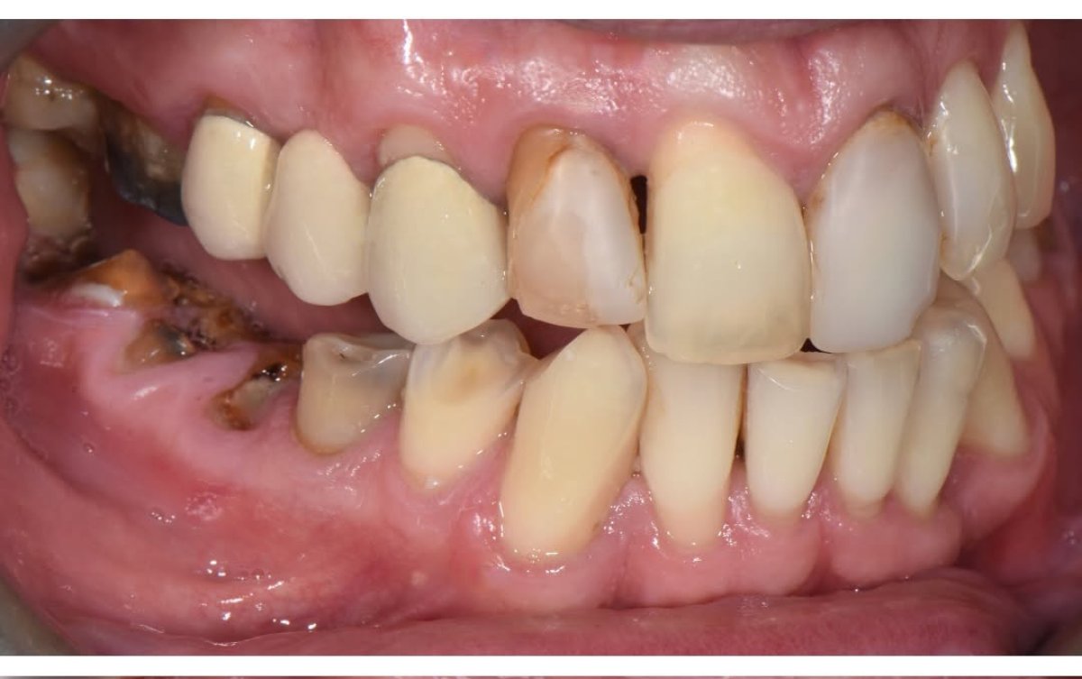 Resultado antes de smile makeover en clínica: caries dental y dientes dañados visibles