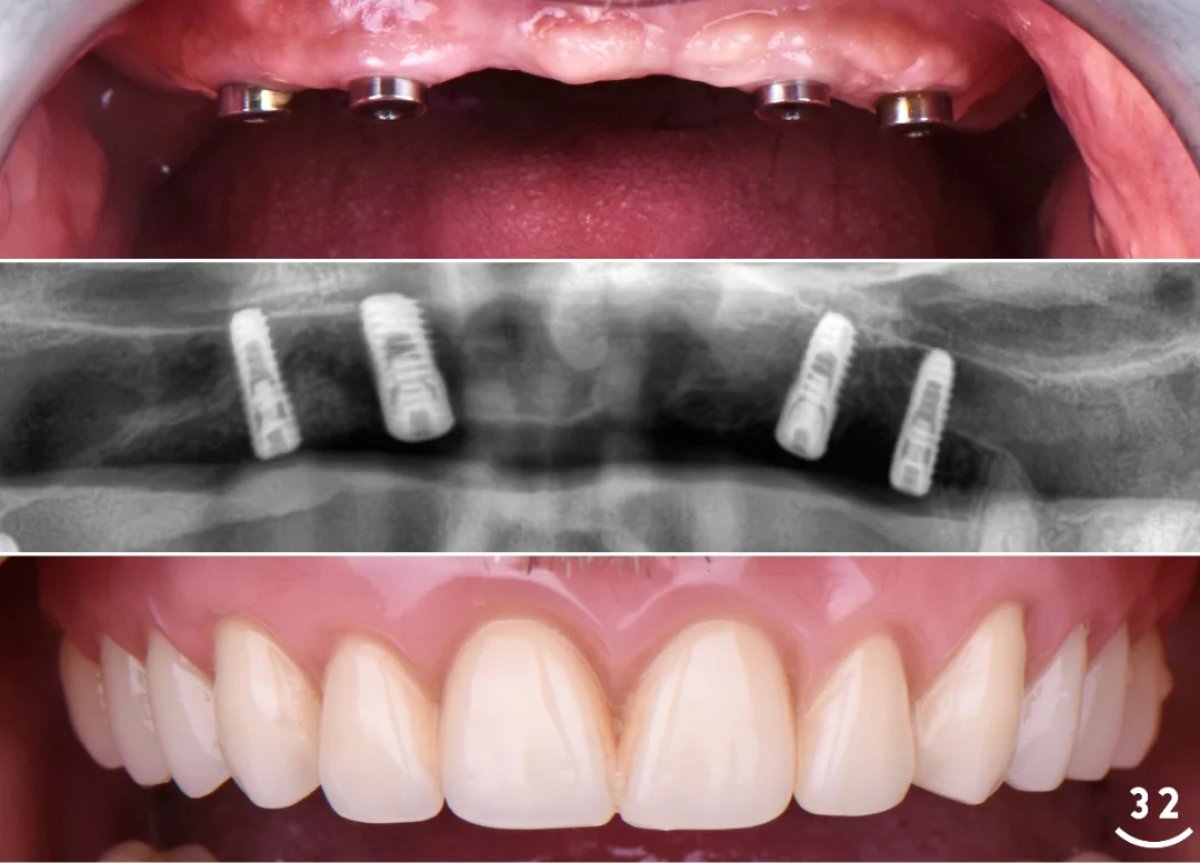 Full-arch implant-fixed zirconia dentures result with 8 titanium implants, before and after