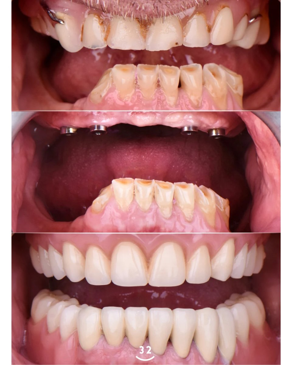 Full-arch implant-fixed zirconia dentures result with 8 titanium implants, before and after