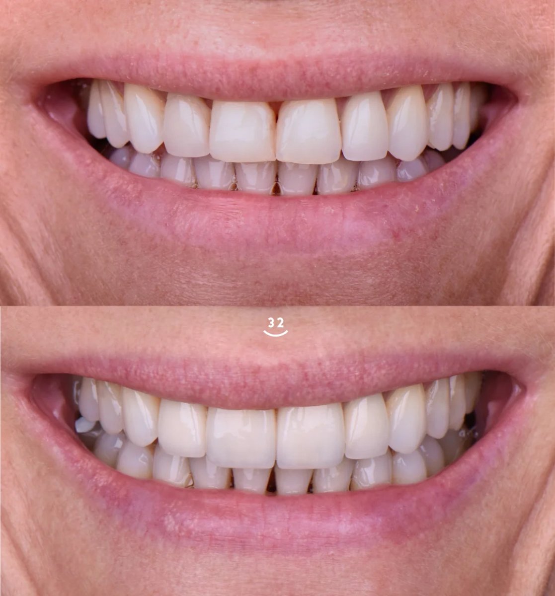 Before and after tooth whitening results – visibly brighter smile after procedure
