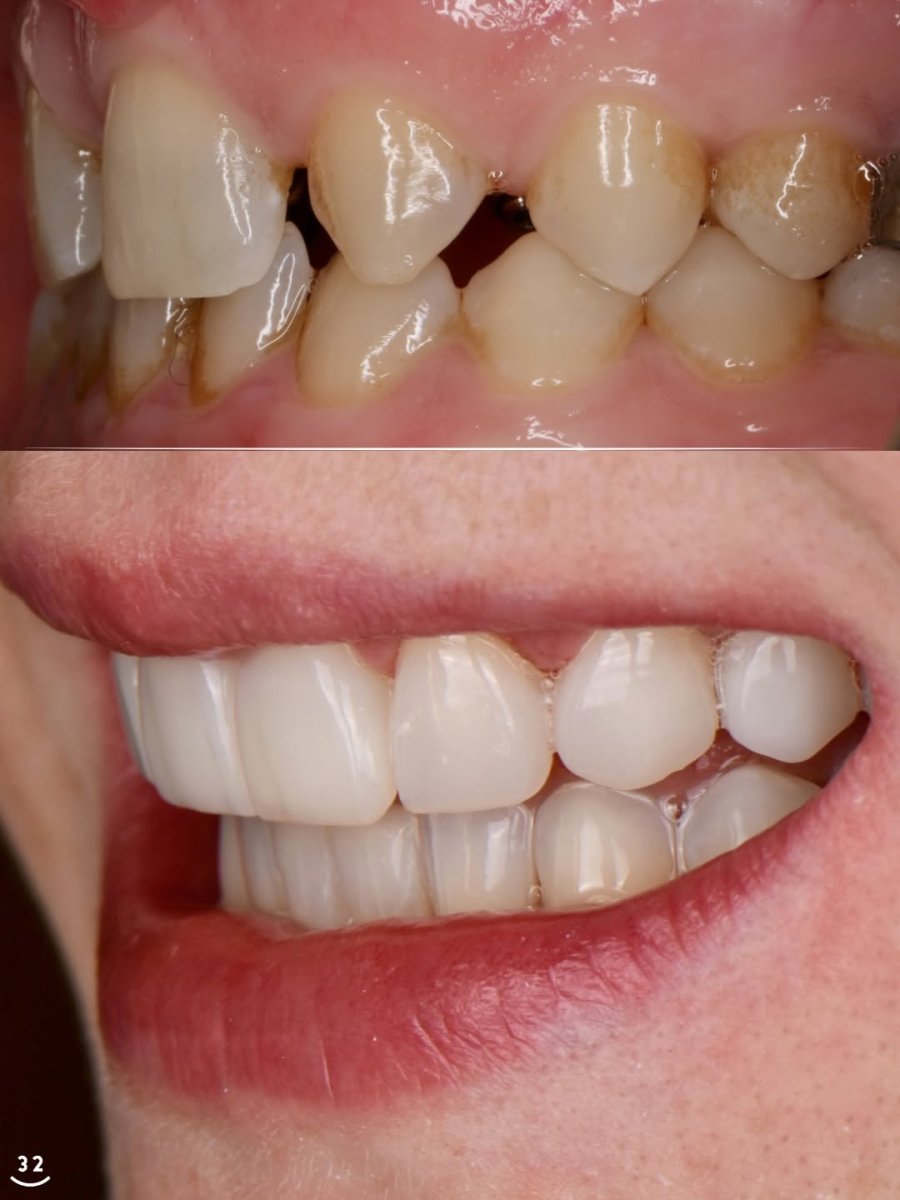 Before and after tooth whitening results – brighter, whiter smile transformation